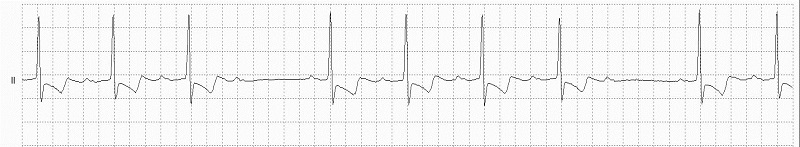 2° AV block Rhythm Strip